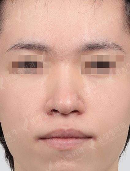Rhinoplasty+3 Types Face Countouring — Before