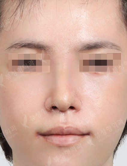 Rhinoplasty+3 Types Face Countouring — After
