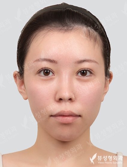 Double Jaw + 3 Types Face Countouring — Before
