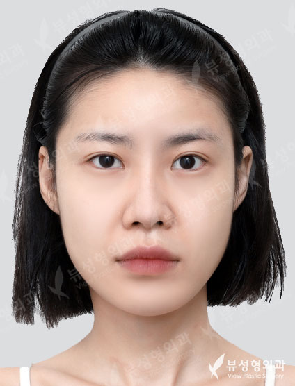 2 Types Face Countouring + Pyriform Augmentation + Revisional Rhinoplasty — Before