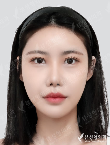 2 Types Face Countouring + Pyriform Augmentation + Revisional Rhinoplasty — After