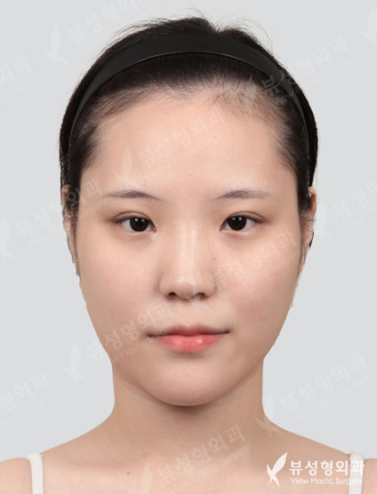 Rhinoplasty + Lateral Canthoplasty + Lower Canthoplasty + Epicanthoplasty — Before