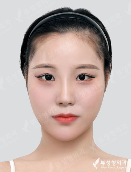 Rhinoplasty + Lateral Canthoplasty + Lower Canthoplasty + Epicanthoplasty — After