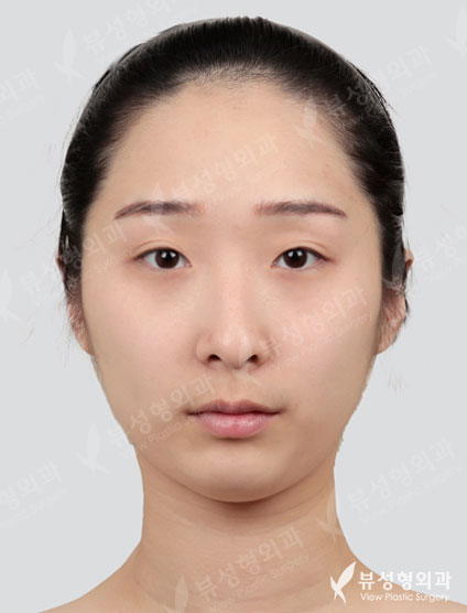 [Double Eyelid Surgery+Epicanthoplasty, Lateral Canthoplasty, Lateral Hotz Canthoplasty+Rhinoplast] — Before
