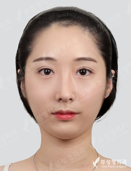 [Double Eyelid Surgery+Epicanthoplasty, Lateral Canthoplasty, Lateral Hotz Canthoplasty+Rhinoplast] — After