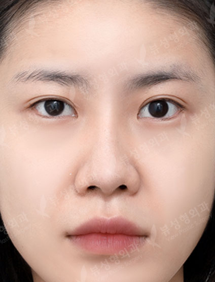 2 Types Face Countouring + Revisional Rhinoplasty +  Pyriform Augmentation — Before