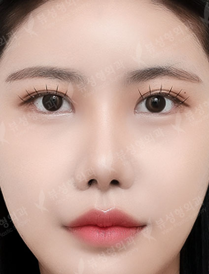 2 Types Face Countouring + Revisional Rhinoplasty +  Pyriform Augmentation — After