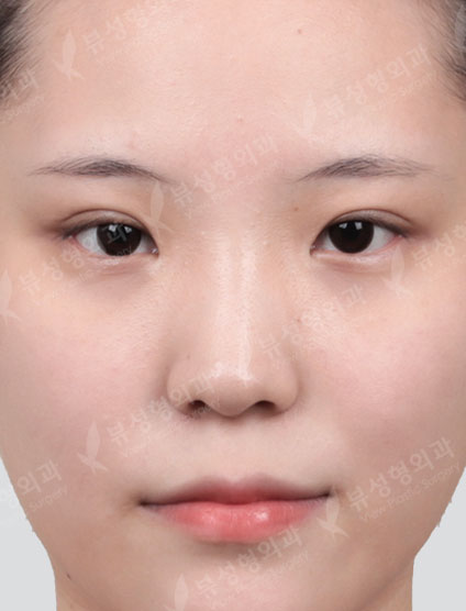 Rhinoplasty + Lateral Canthoplasty + Lower Canthoplasty + Epicanthoplasty — Before