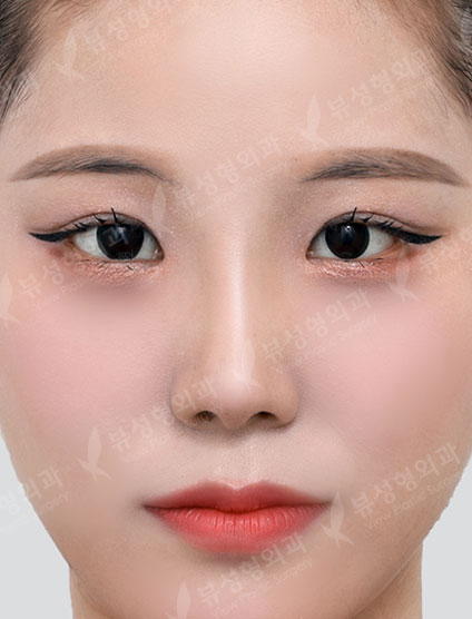 Rhinoplasty + Lateral Canthoplasty + Lower Canthoplasty + Epicanthoplasty — After