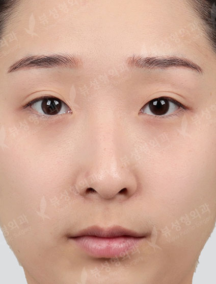 Double eyelid surgery + ptosis correction + Epi,Lateral,Lower Canthoplasty + Rhinoplasty — Before