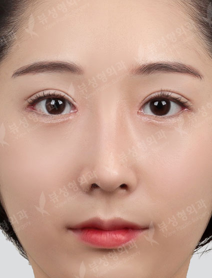 Double eyelid surgery + ptosis correction + Epi,Lateral,Lower Canthoplasty + Rhinoplasty — After