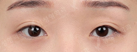 Double eyelid surgery + ptosis correction + Epi,Lateral,Lower Canthoplasty + Rhinoplasty — Before