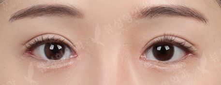 Double eyelid surgery + ptosis correction + Epi,Lateral,Lower Canthoplasty + Rhinoplasty — After