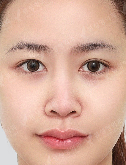Revisional Rhinoplasty — Before