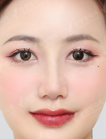 Revisional Rhinoplasty — After