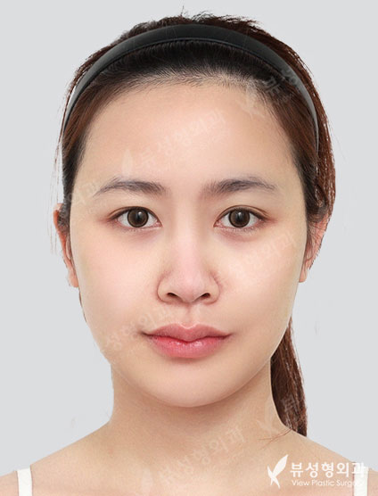 Revisional Rhinoplasty — Before