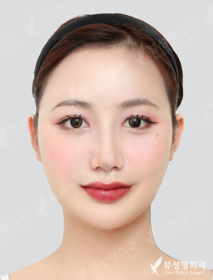 Revisional Rhinoplasty — After