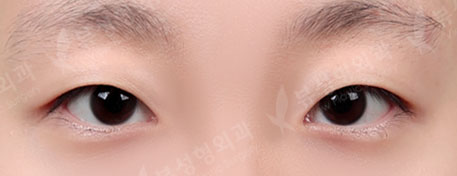 [Double Eyelid Surgery + Epicanthoplasty + Lateral Canthoplasty] — Before