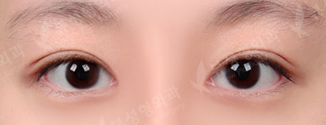 [Double Eyelid Surgery + Epicanthoplasty + Lateral Canthoplasty] — After