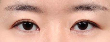 [Double Eyelid Surgery + Epicanthoplasty + Lateral Canthoplasty + Lower Canthoplasty] — Before