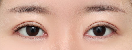 [Double Eyelid Surgery + Epicanthoplasty + Lateral Canthoplasty + Lower Canthoplasty] — After
