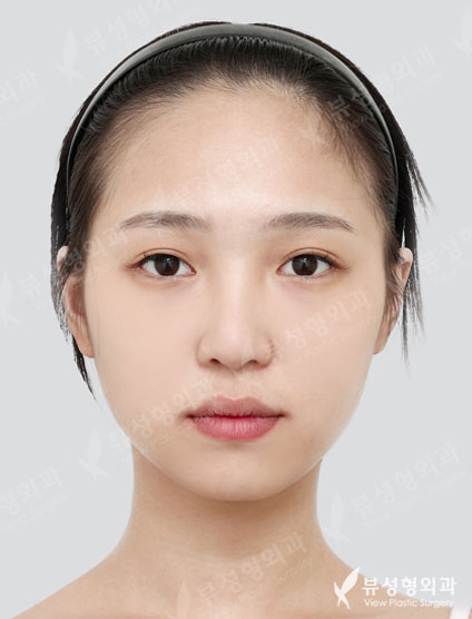 3 Types Face Countouring + Fat Graft (Full face) + Revisional Rhinoplasty — Before