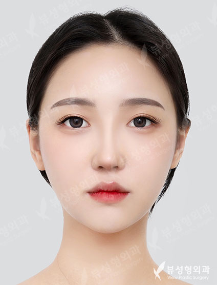 3 Types Face Countouring + Fat Graft (Full face) + Revisional Rhinoplasty — After