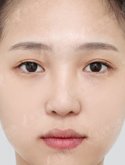 3 Types Face Countouring + Fat Graft (Full face) + Revisional Rhinoplasty — Before