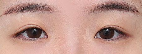 Double Eyelid Revisional Surgery + ptosis correction + Epicanthoplasty + Lateral Canthoplasty — Before