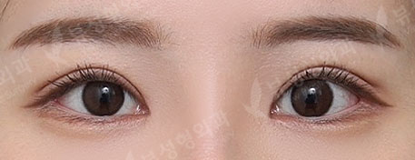 Double Eyelid Revisional Surgery + ptosis correction + Epicanthoplasty + Lateral Canthoplasty — After