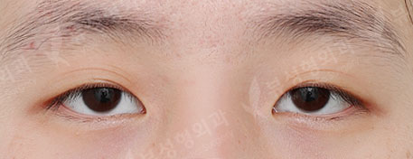 Double Eyelid  Surgery + ptosis correction — Before