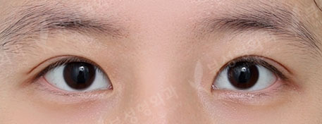 Double Eyelid  Surgery + ptosis correction — After
