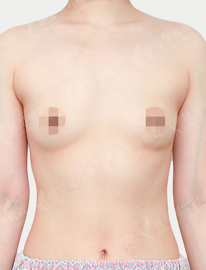 Breast Augmentation (Motiva) — Before