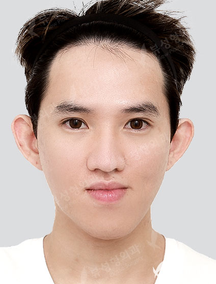 Two-jaw + Facial Contouring — Before
