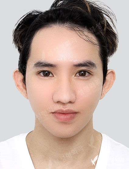 Two-jaw + Facial Contouring — After