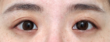 Rhinoplasty + Double Eyelid Surgery — Before