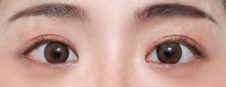 Rhinoplasty + Double Eyelid Surgery — After