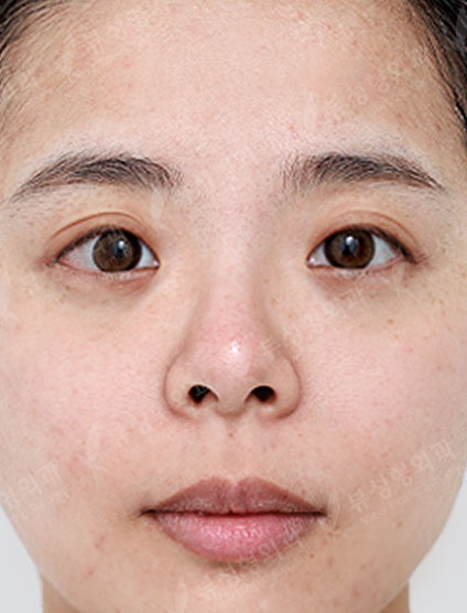 Rhinoplasty + Double Eyelid Surgery — Before