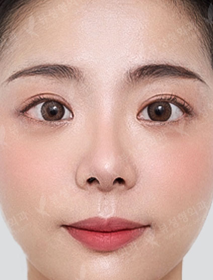 Rhinoplasty + Double Eyelid Surgery — After