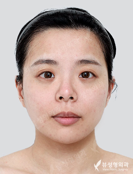 Rhinoplasty + Double Eyelid Surgery — Before