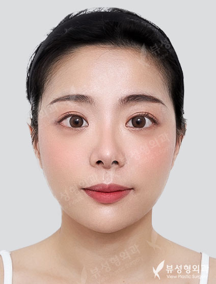 Rhinoplasty + Double Eyelid Surgery — After
