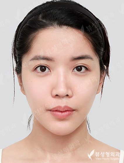 Rhinoplasty + Double Eyelid Surgery — Before
