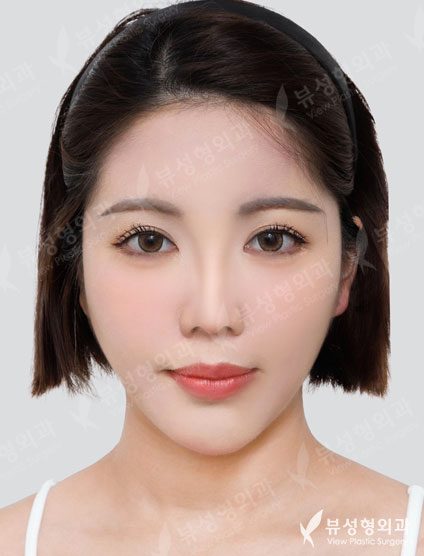 Rhinoplasty + Double Eyelid Surgery — After
