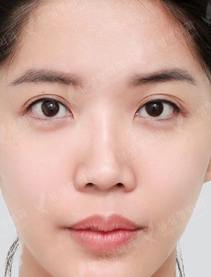 Rhinoplasty + Double Eyelid Surgery — Before
