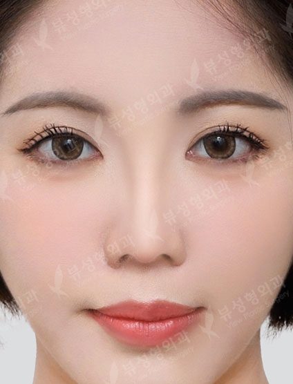 Rhinoplasty + Double Eyelid Surgery — After