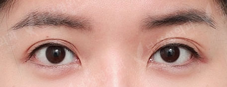 Rhinoplasty + Double Eyelid Surgery — Before
