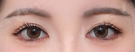 Rhinoplasty + Double Eyelid Surgery — After