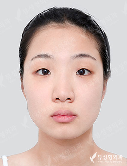 Facial Contouring + Rhinoplasty + Double Eyelid Surgery — Before