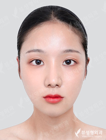 Facial Contouring + Rhinoplasty + Double Eyelid Surgery — After