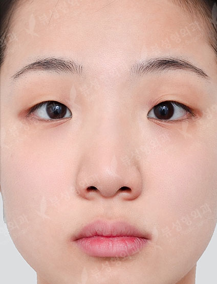 Rhinoplasty + Facial Contouring + Double Eyelid Surgery — Before